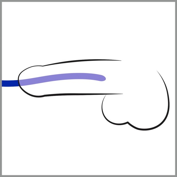 DILATATORI URETRALI SET 3 DIVERSE MISURE SILICONE