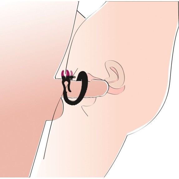 DUE PINZE CHE APRONO LE  LABBRA VAGINALI REGOLABILI SPREADER
